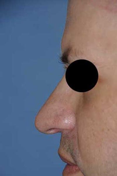 Rhinoplasty Before & After Gallery - Patient 397487 - Image 1
