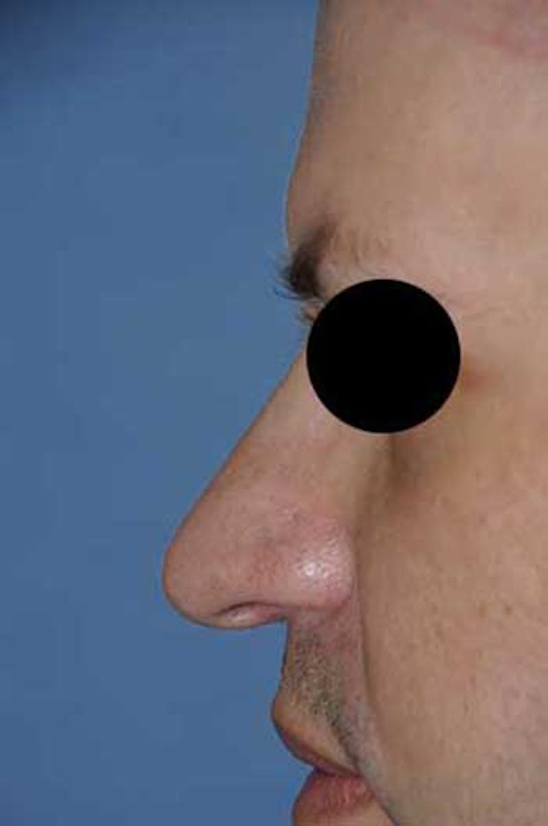 Rhinoplasty Before & After Gallery - Patient 397487 - Image 1