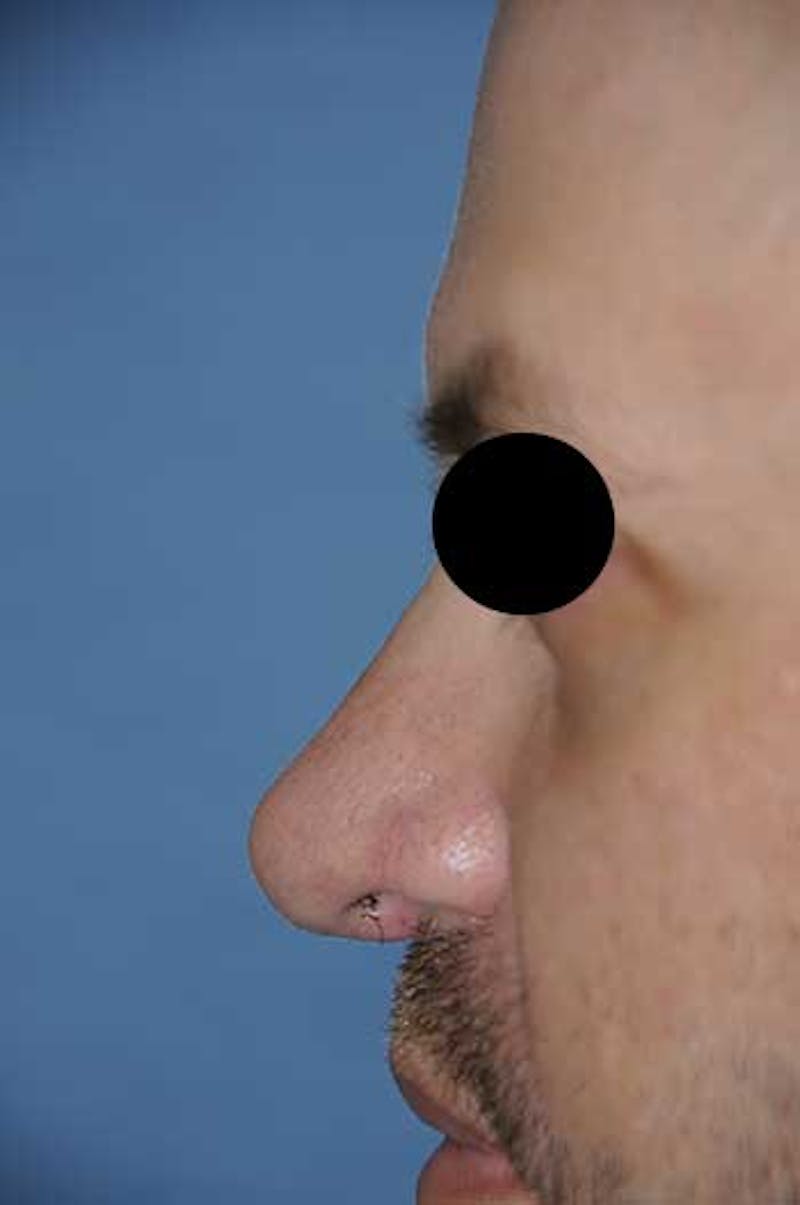 Rhinoplasty Before & After Gallery - Patient 397487 - Image 2