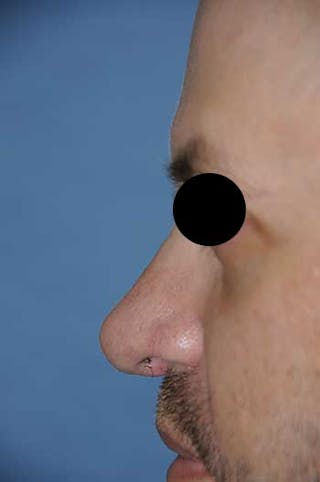 Rhinoplasty Before & After Gallery - Patient 397487 - Image 2