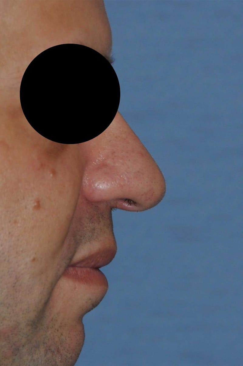 Rhinoplasty Before & After Gallery - Patient 397487 - Image 3