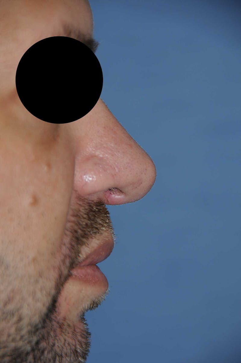 Rhinoplasty Before & After Gallery - Patient 397487 - Image 4