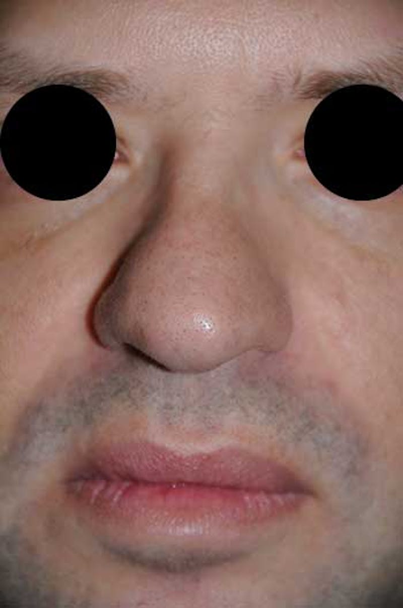 Rhinoplasty Before & After Gallery - Patient 397487 - Image 5