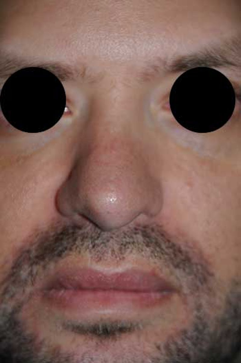 Rhinoplasty Before & After Gallery - Patient 397487 - Image 6