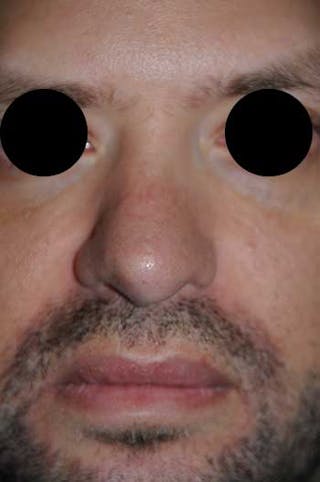 Rhinoplasty Before & After Gallery - Patient 397487 - Image 6