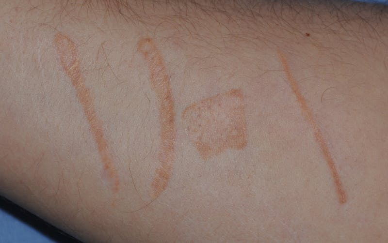 Scar Revision Before & After Gallery - Patient 336750 - Image 1