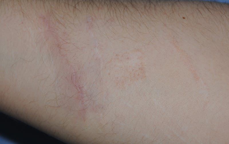 Scar Revision Before & After Gallery - Patient 336750 - Image 2