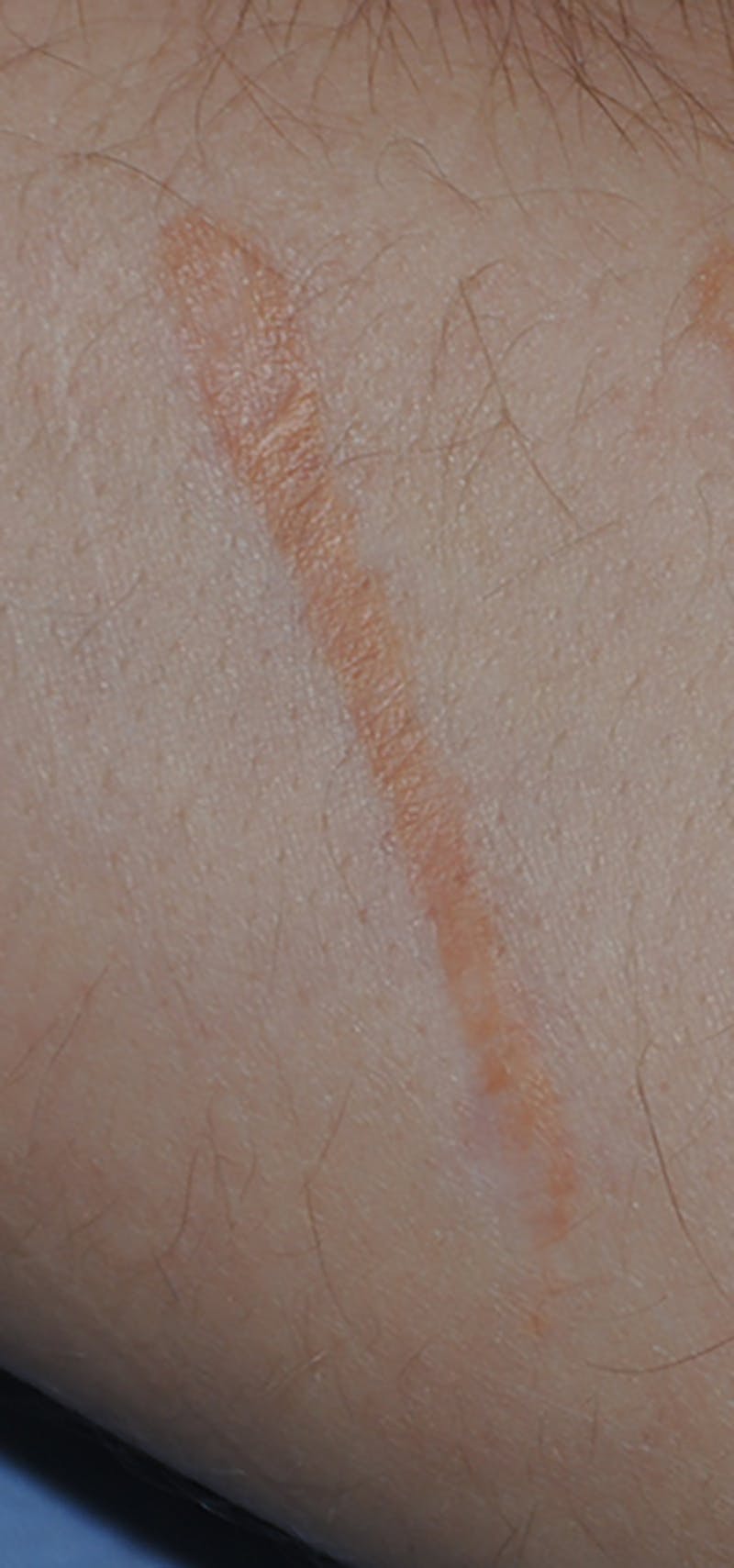 Scar Revision Before & After Gallery - Patient 336750 - Image 3