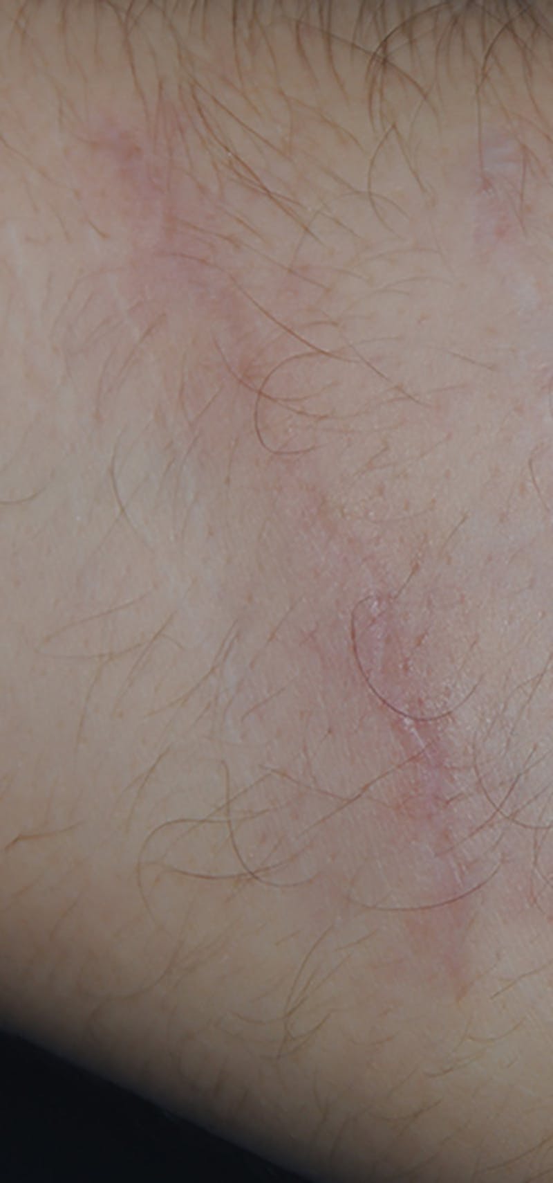 Scar Revision Before & After Gallery - Patient 336750 - Image 4