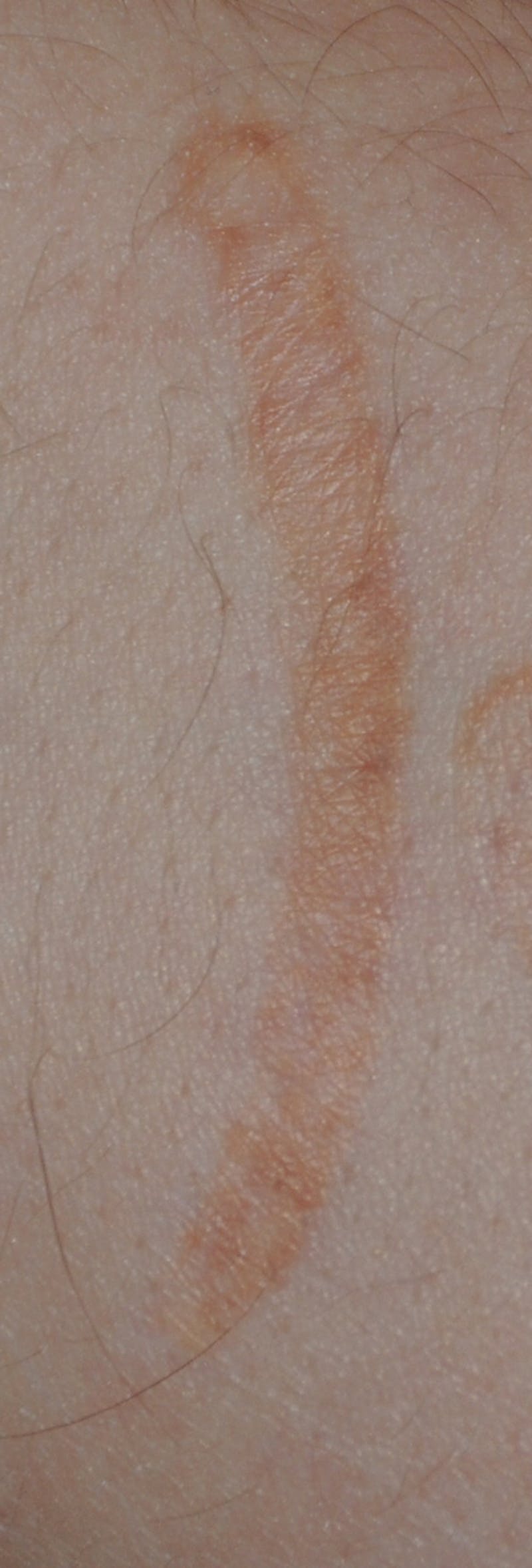 Scar Revision Before & After Gallery - Patient 336750 - Image 5