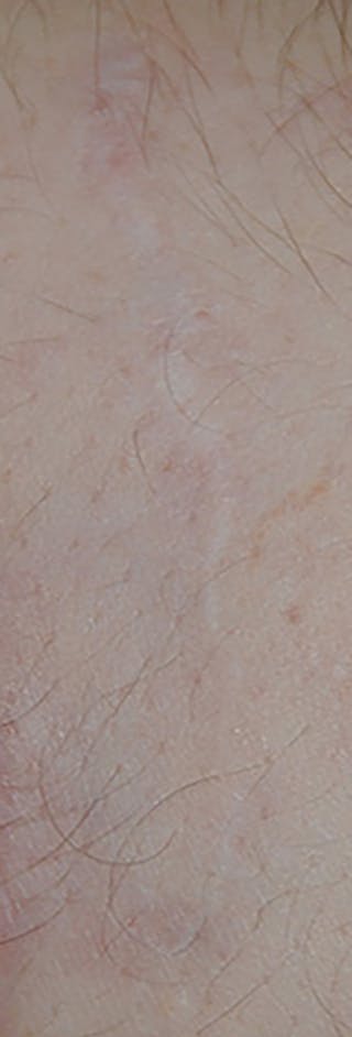 Scar Revision Before & After Gallery - Patient 336750 - Image 6