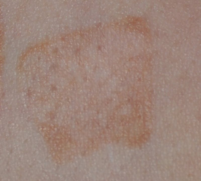 Scar Revision Before & After Gallery - Patient 336750 - Image 7