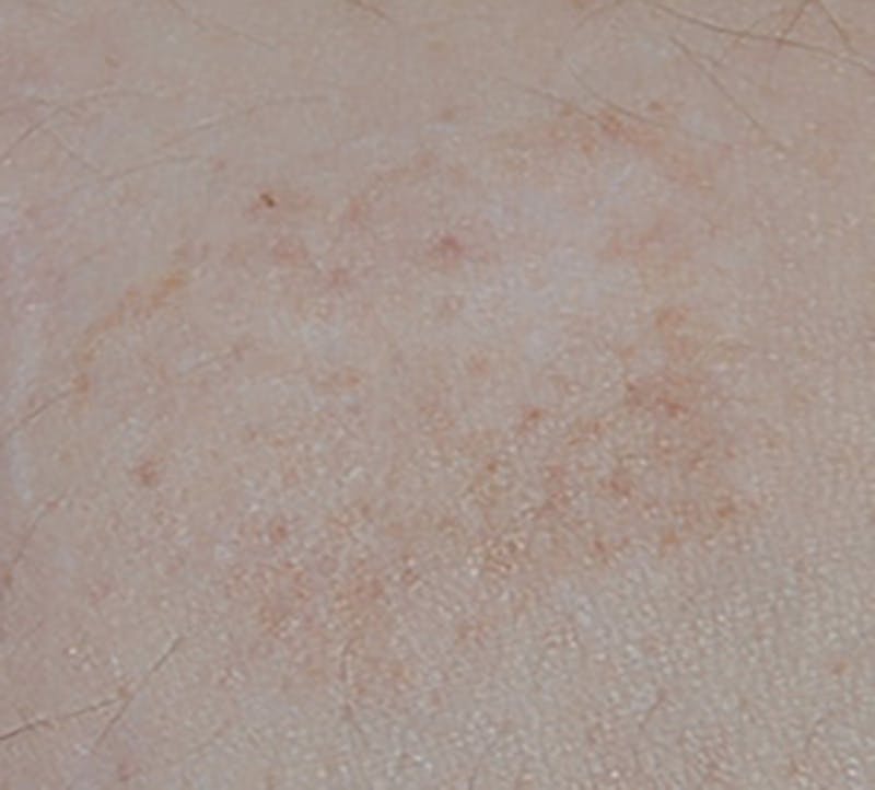 Scar Revision Before & After Gallery - Patient 336750 - Image 8