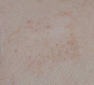 Scar Revision Before & After Gallery - Patient 336750 - Image 8
