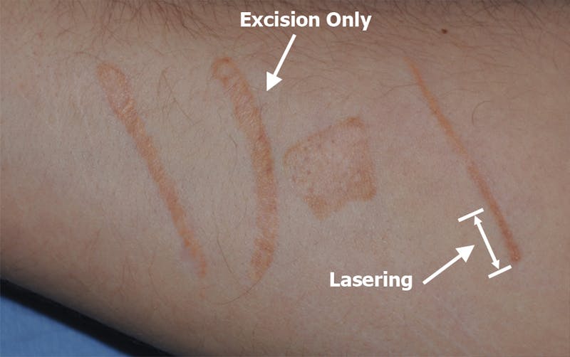 Scar Revision Before & After Gallery - Patient 336750 - Image 9