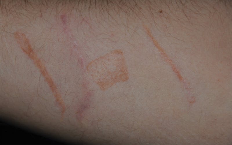 Scar Revision Before & After Gallery - Patient 336750 - Image 10