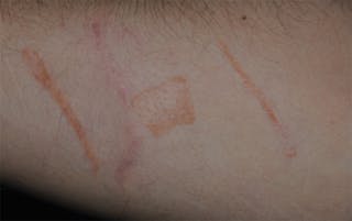 Scar Revision Before & After Gallery - Patient 336750 - Image 10