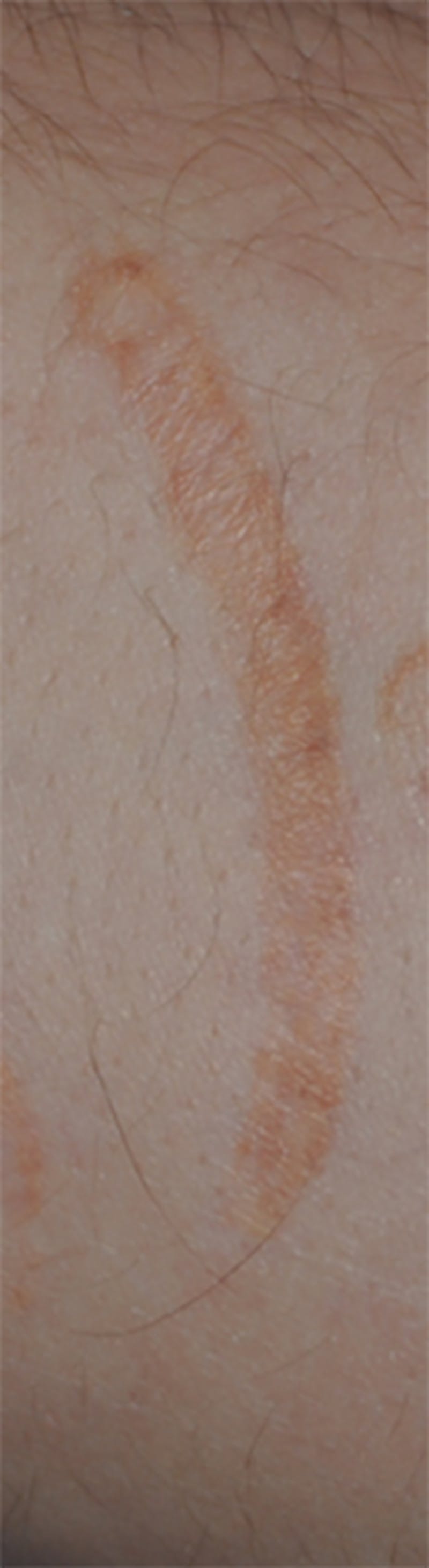 Scar Revision Before & After Gallery - Patient 336750 - Image 11