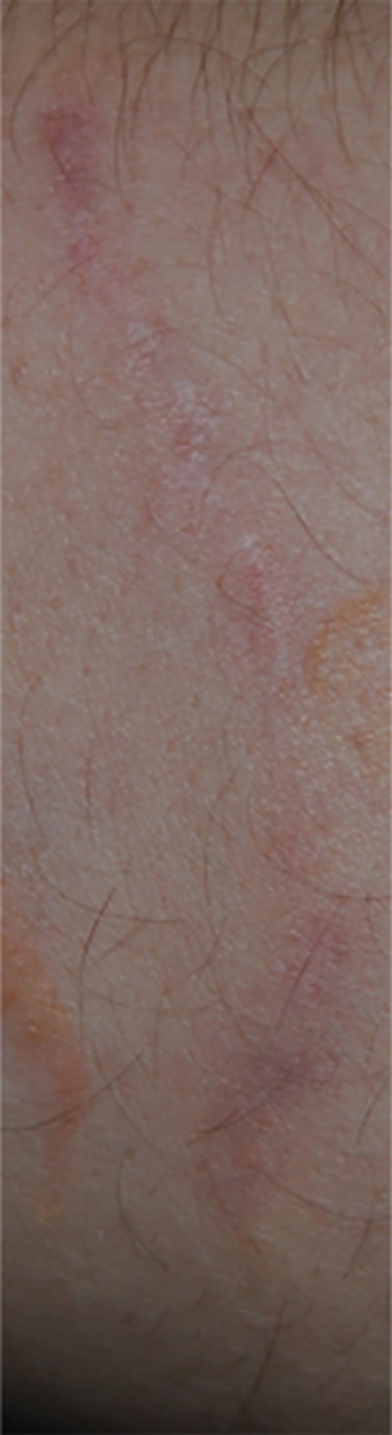 Scar Revision Before & After Gallery - Patient 336750 - Image 12