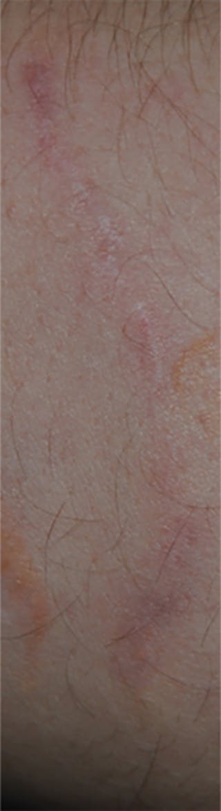 Scar Revision Before & After Gallery - Patient 336750 - Image 12