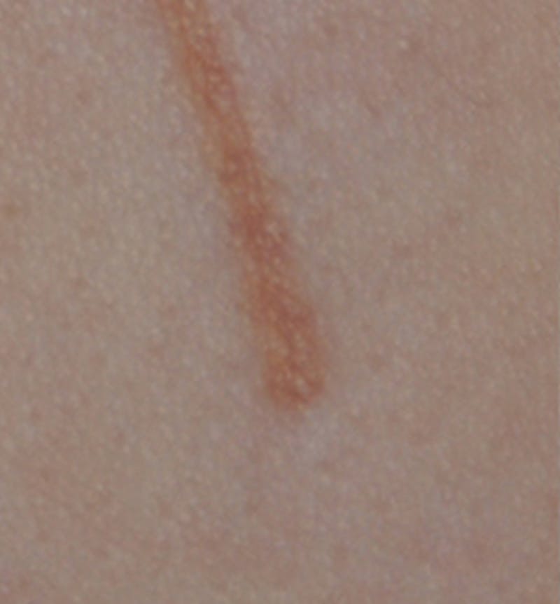 Scar Revision Before & After Gallery - Patient 336750 - Image 13