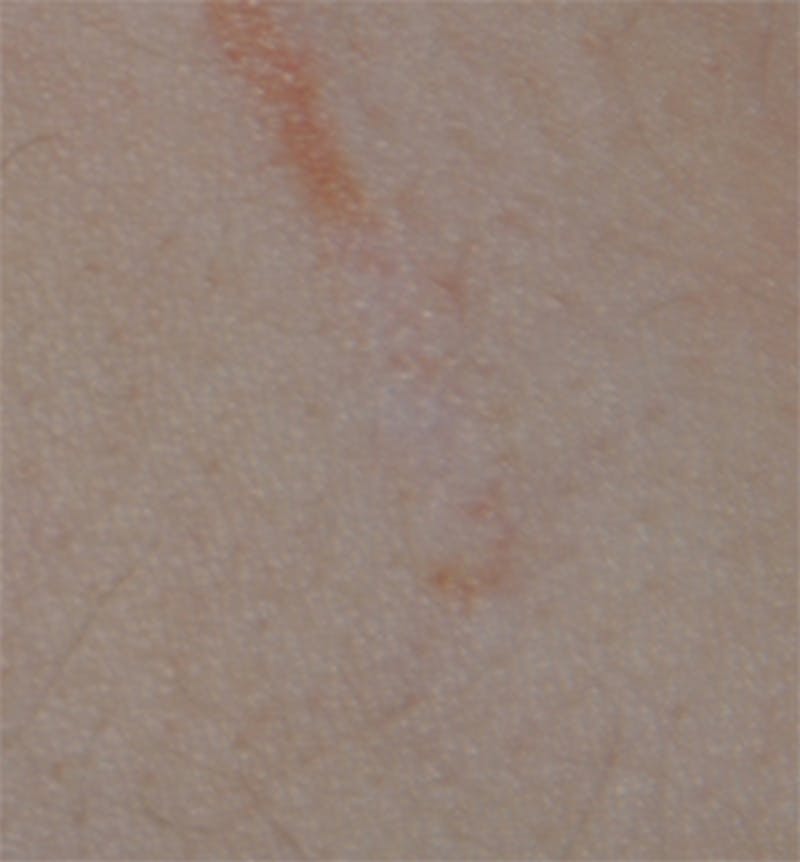 Scar Revision Before & After Gallery - Patient 336750 - Image 14
