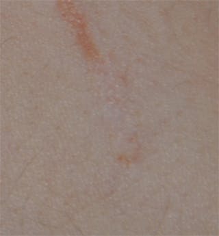 Scar Revision Before & After Gallery - Patient 336750 - Image 14