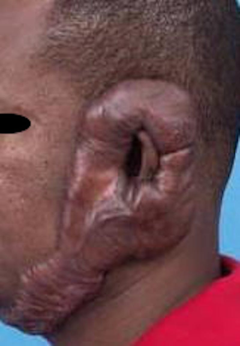 Scar Revision Before & After Gallery - Patient 260717 - Image 1