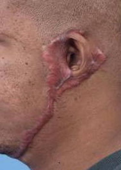 Scar Revision Before & After Gallery - Patient 260717 - Image 2