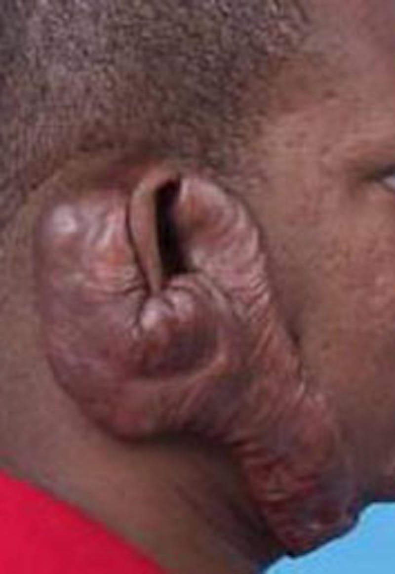 Scar Revision Before & After Gallery - Patient 260717 - Image 3