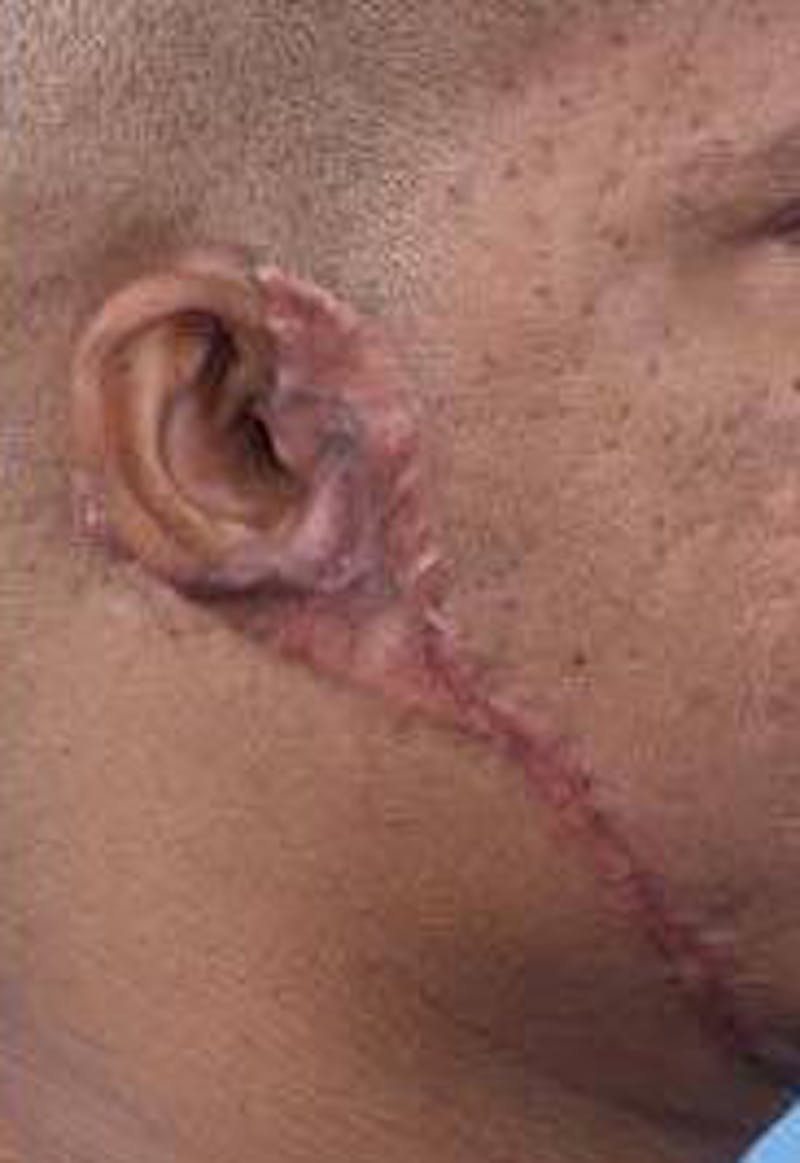 Scar Revision Before & After Gallery - Patient 260717 - Image 4