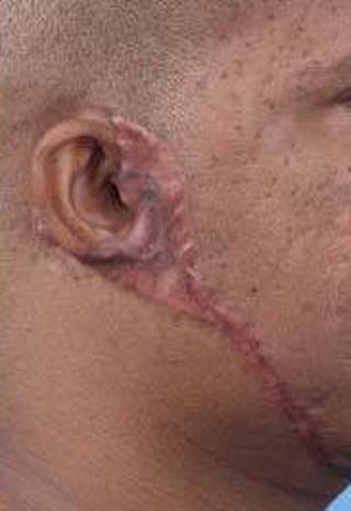 Scar Revision Before & After Gallery - Patient 260717 - Image 4