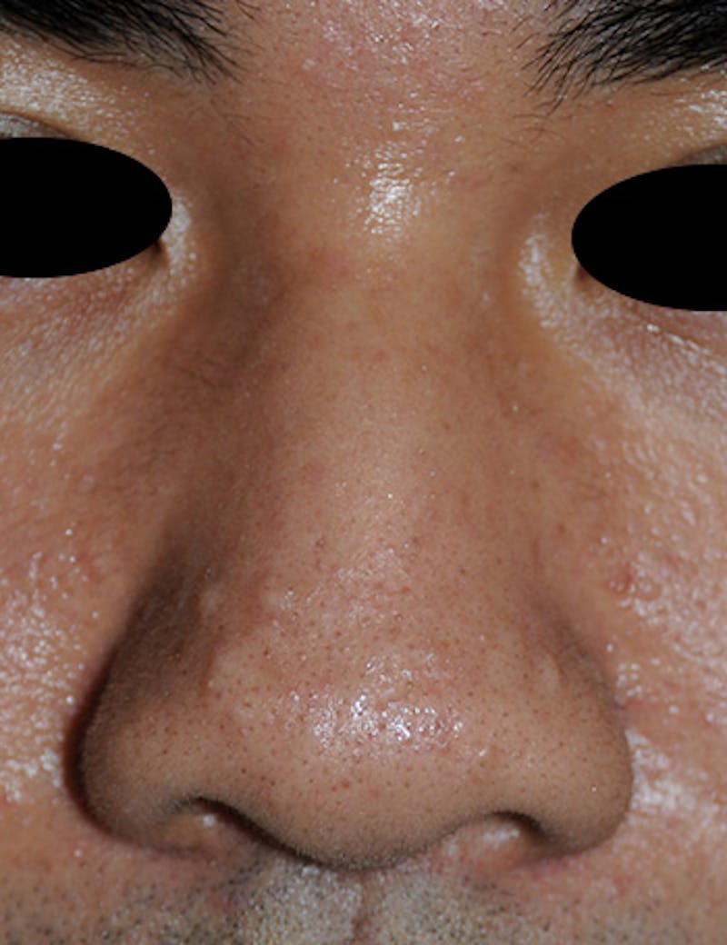 Scar Revision Before & After Gallery - Patient 389448 - Image 1