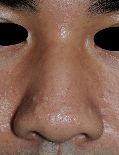 Scar Revision Before & After Gallery - Patient 389448 - Image 1
