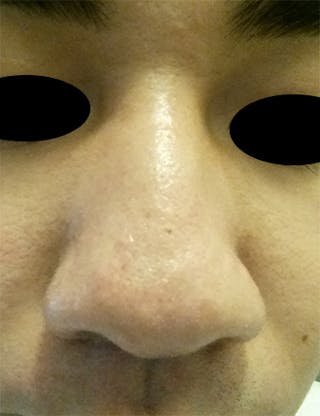 Scar Revision Before & After Gallery - Patient 389448 - Image 2