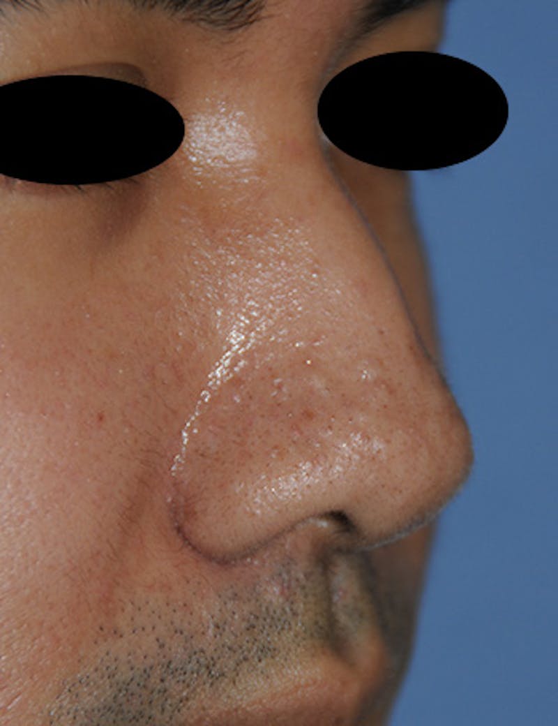 Scar Revision Before & After Gallery - Patient 389448 - Image 3