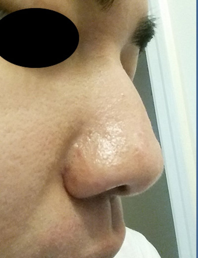Scar Revision Before & After Gallery - Patient 389448 - Image 4