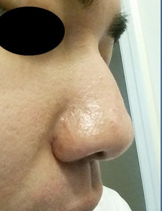 Scar Revision Before & After Gallery - Patient 389448 - Image 4