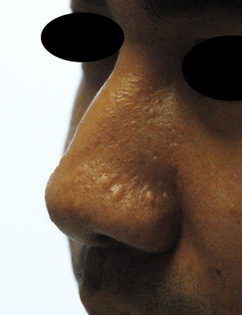 Scar Revision Before & After Gallery - Patient 389448 - Image 5