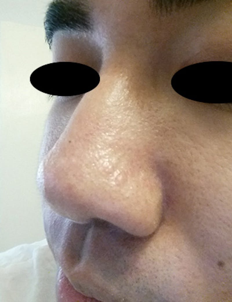 Scar Revision Before & After Gallery - Patient 389448 - Image 6