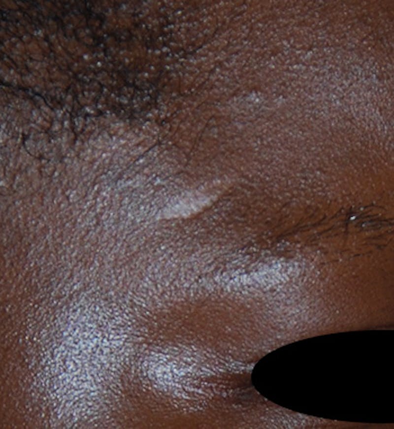 Scar Revision Before & After Gallery - Patient 425665 - Image 1