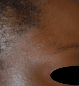 Scar Revision Before & After Gallery - Patient 425665 - Image 2