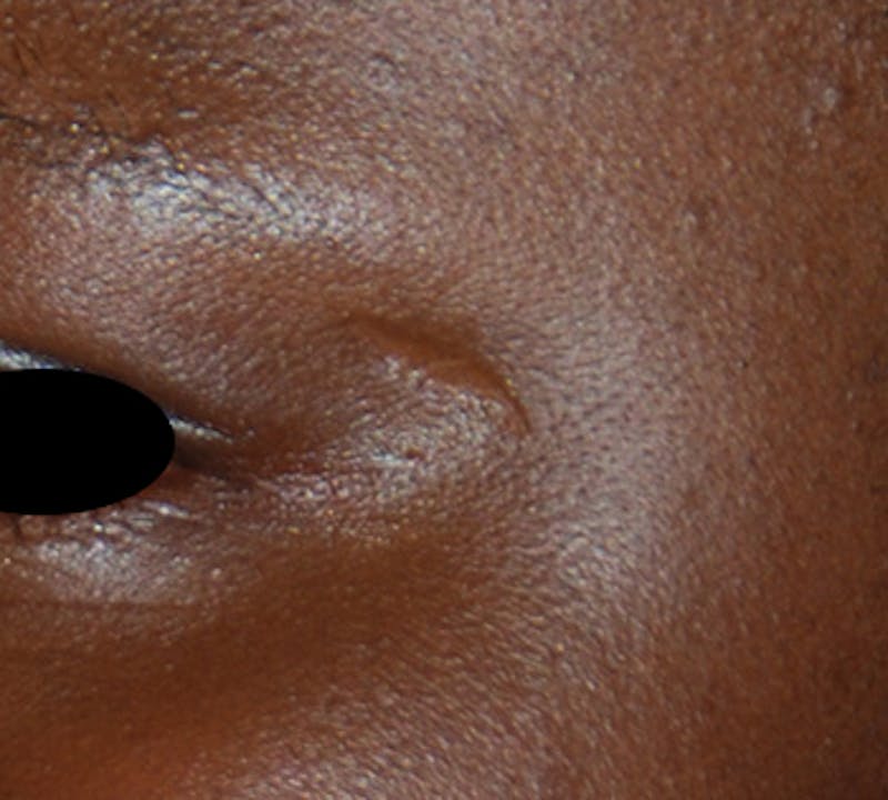 Scar Revision Before & After Gallery - Patient 425665 - Image 3