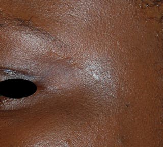 Scar Revision Before & After Gallery - Patient 425665 - Image 4