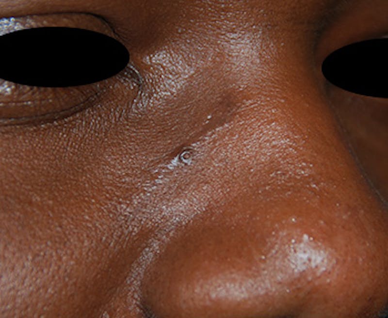 Scar Revision Before & After Gallery - Patient 425665 - Image 5