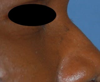 Scar Revision Before & After Gallery - Patient 425665 - Image 6