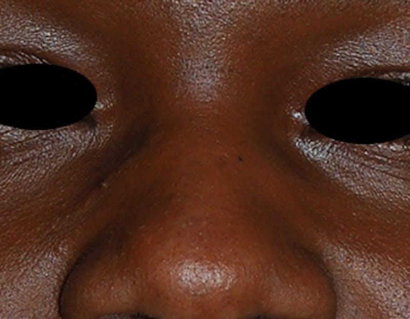 Scar Revision Before & After Gallery - Patient 425665 - Image 7