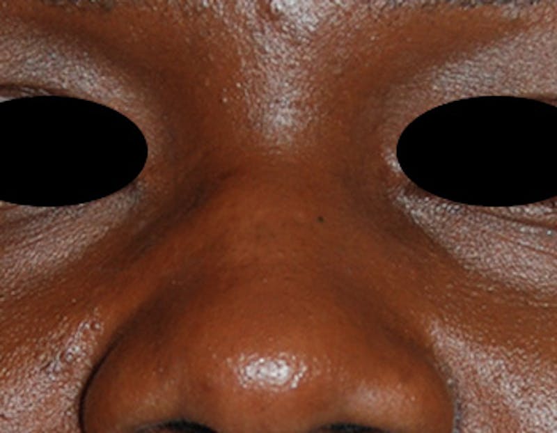 Scar Revision Before & After Gallery - Patient 425665 - Image 8