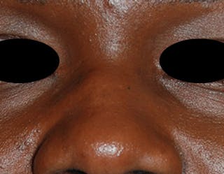 Scar Revision Before & After Gallery - Patient 425665 - Image 8