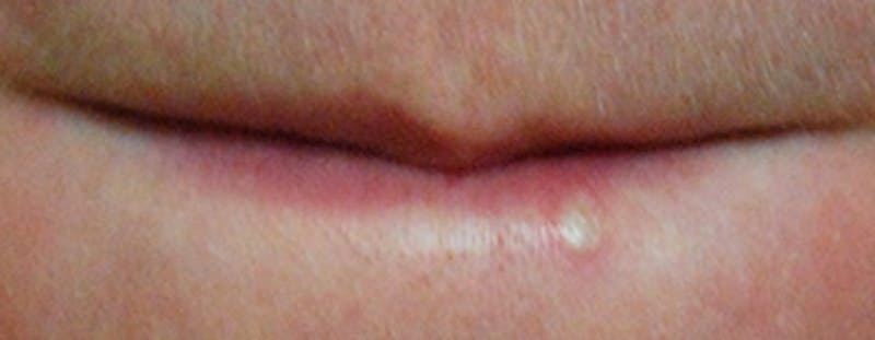 Laser Resurfacing Before & After Gallery - Patient 424384 - Image 1